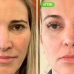 10 Critical Things to Know Before Getting Tear Trough Fillers