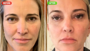 10 Critical Things to Know Before Getting Tear Trough Fillers