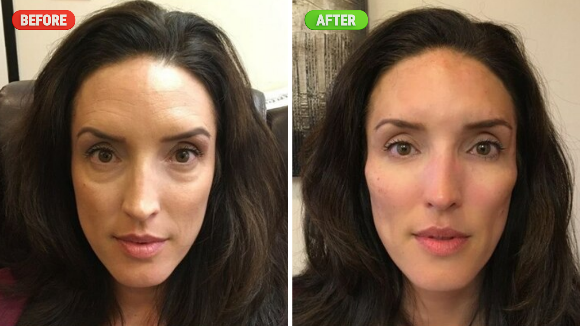Tear-Trough-Filler- of a female