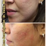 The Role of Collagen in Healing Acne Scars and Promoting Skin Health