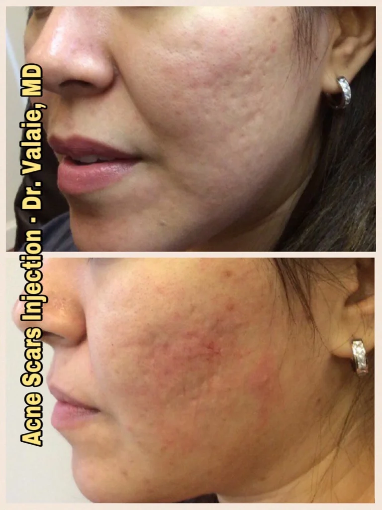 acne scars treatement