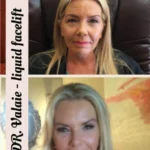 How to Achieve a Youthful Look with a Liquid Facelift for Jowls 